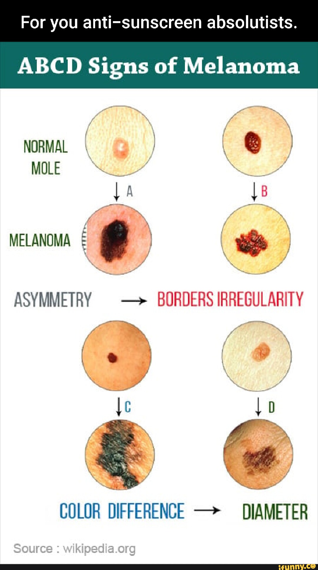 For you anti-sunscreen absolutists. ABCD Signs of Melanoma NORMAL MOLE ...