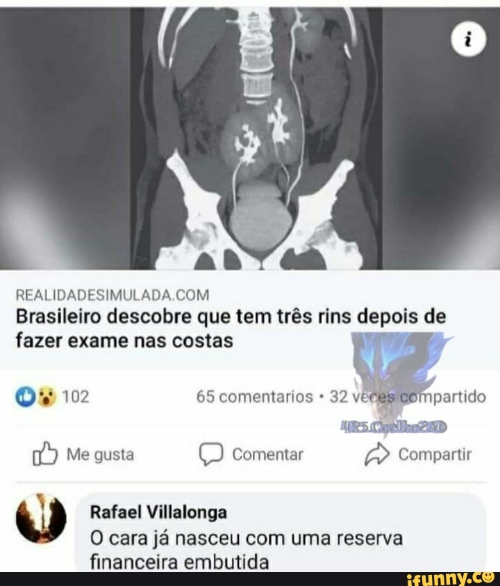 REALIDADESIMULADA COM
Brasileiro descobre que tem três rins depois de fazer exame nas costas
O% 102 65 comentarios 32 vê partido
RS Coelhe
Me gusta ) Comentar Compartir
Rafael Villalonga
O cara já nasceu com uma reserva
financeira embutida