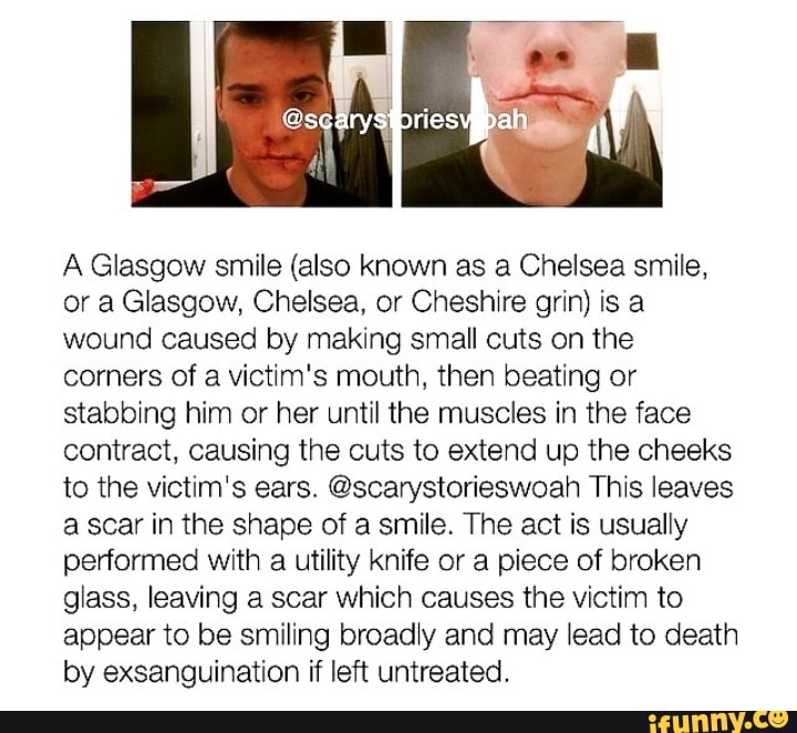 A Glasgow smile (also known as 3 Chelsea smile, or a Glasgow, Chelsea ...