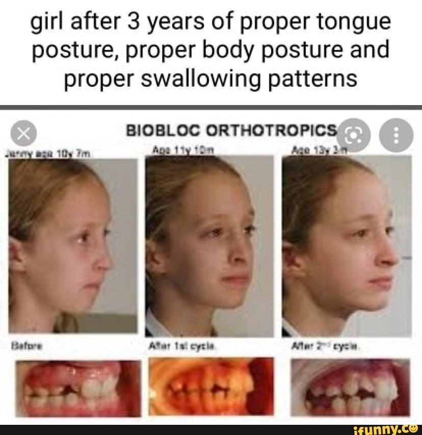 Girl After 3 Years Of Proper Tongue Posture Proper Body Posture And