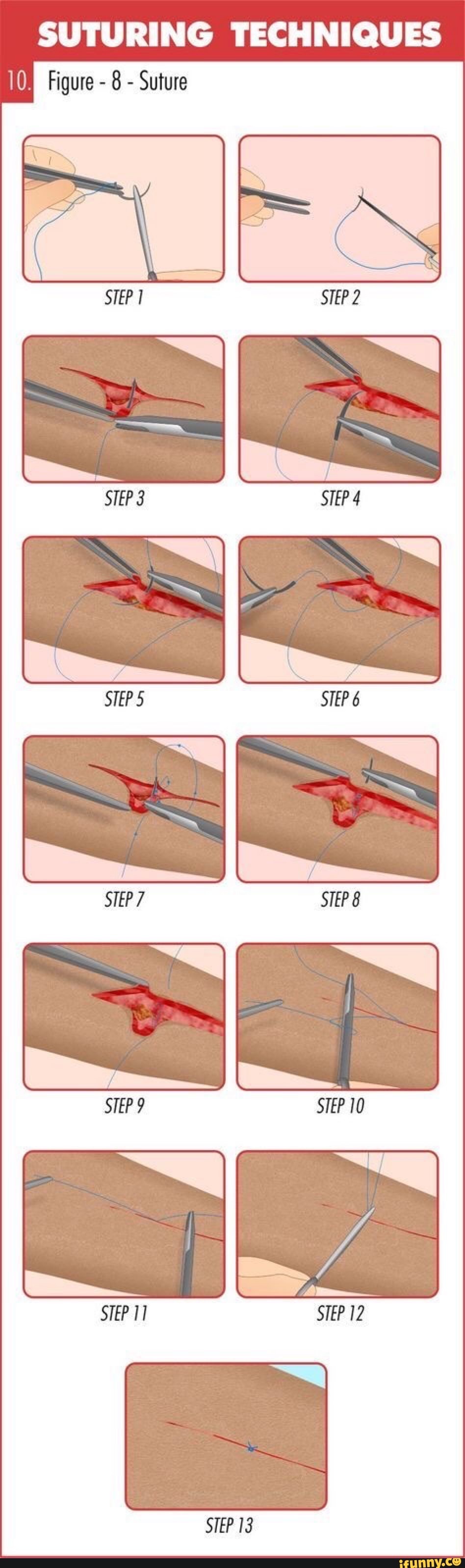 10. SUTURING TECHNIQUES Figure - 8 - Suture STEP 11 STEP 12 - iFunny