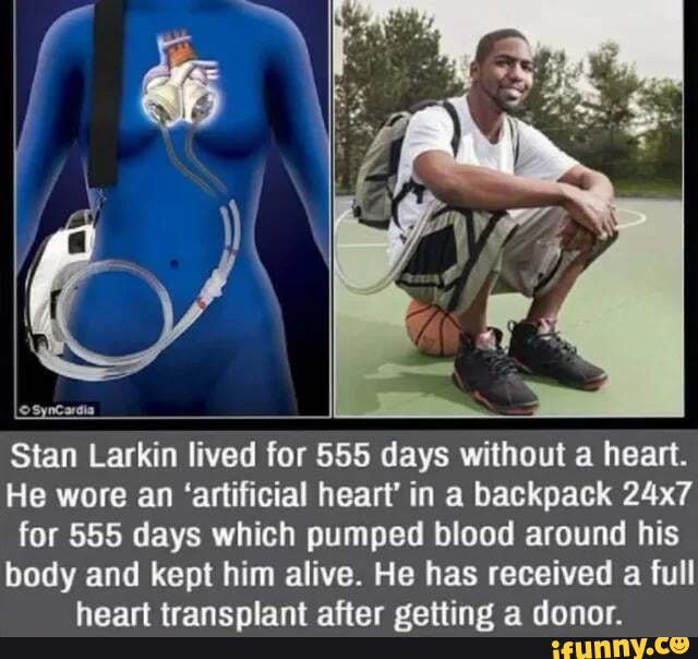 Stan Larkin lived for 555 days without a heart. He wore an 'artificial