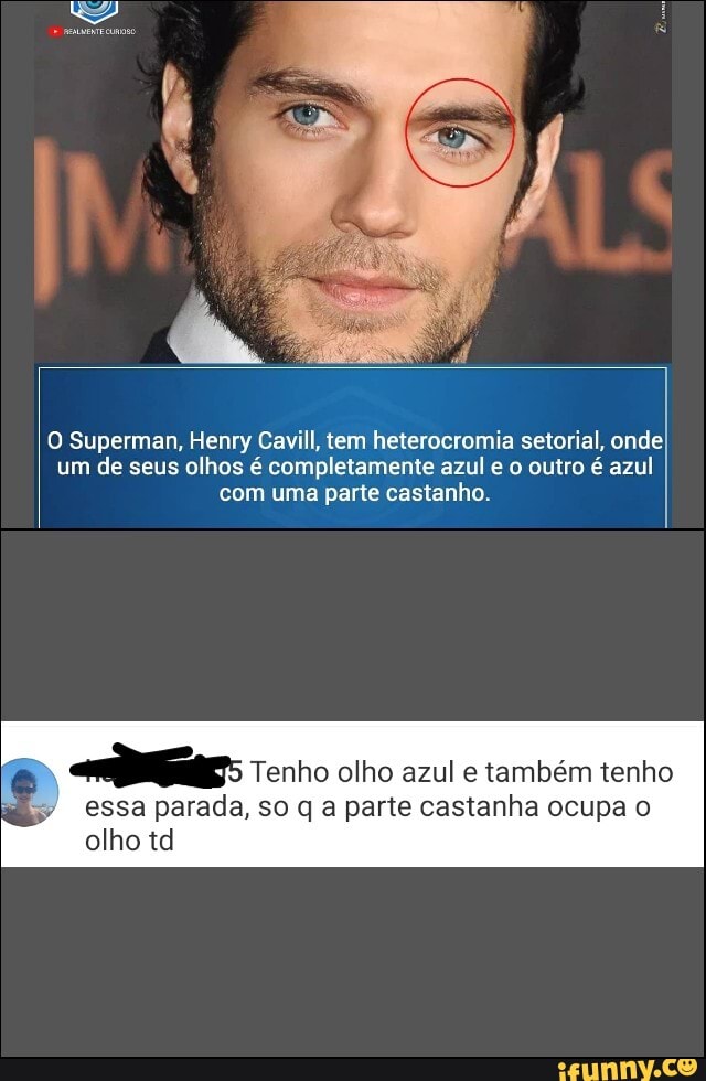 O Superman, Henry Cavill, tem heterocromia setorial, onde; um de seus olhos é completamente azul e o outro é azul com uma parte castanho.
Tenho olho azul e também tenho
essa parada, so q a parte castanha ocupa o olho td