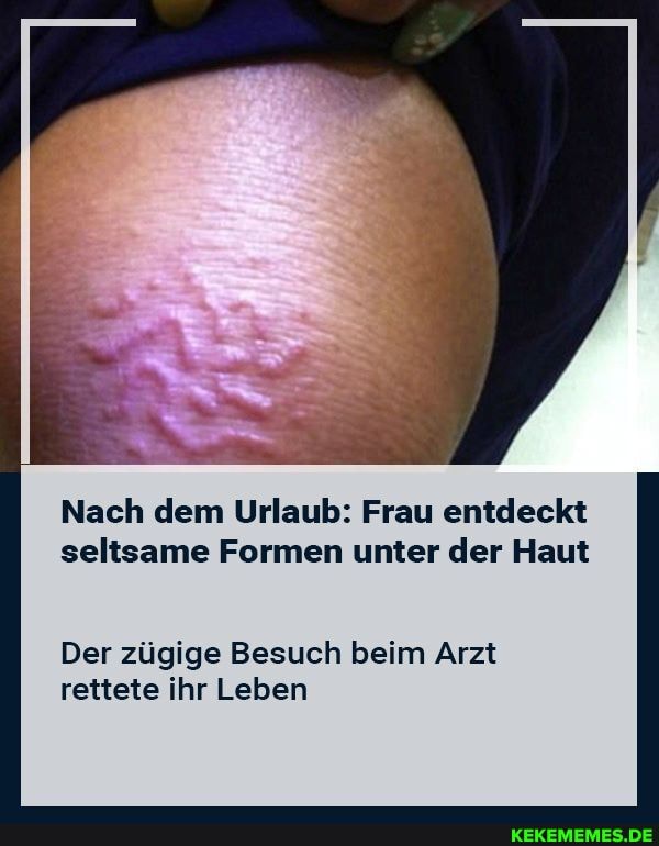 Nach dem Urlaub: Frau entdeckt seltsame Formen unter der Haut
Der zügige Besuch beim Arzt rettete ihr Leben
