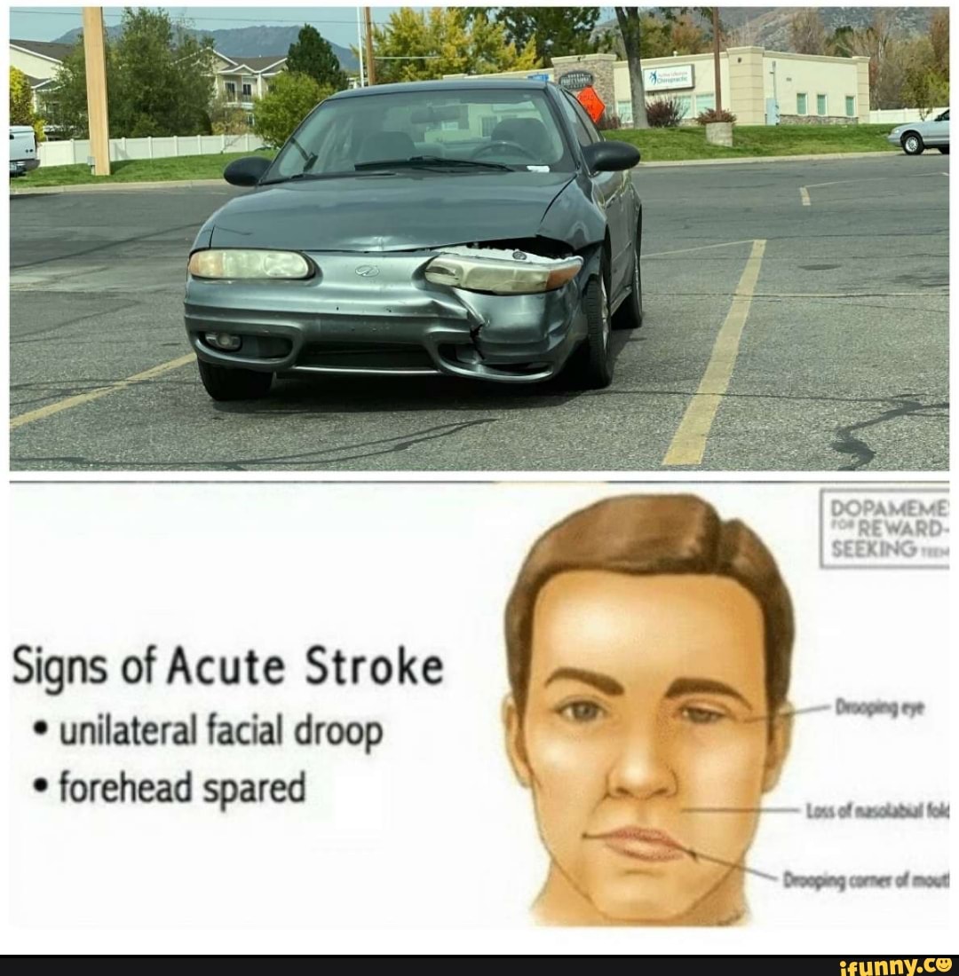 Signs Of Acute Stroke Unilateral Facial Droop Forehead Spared Ifunny