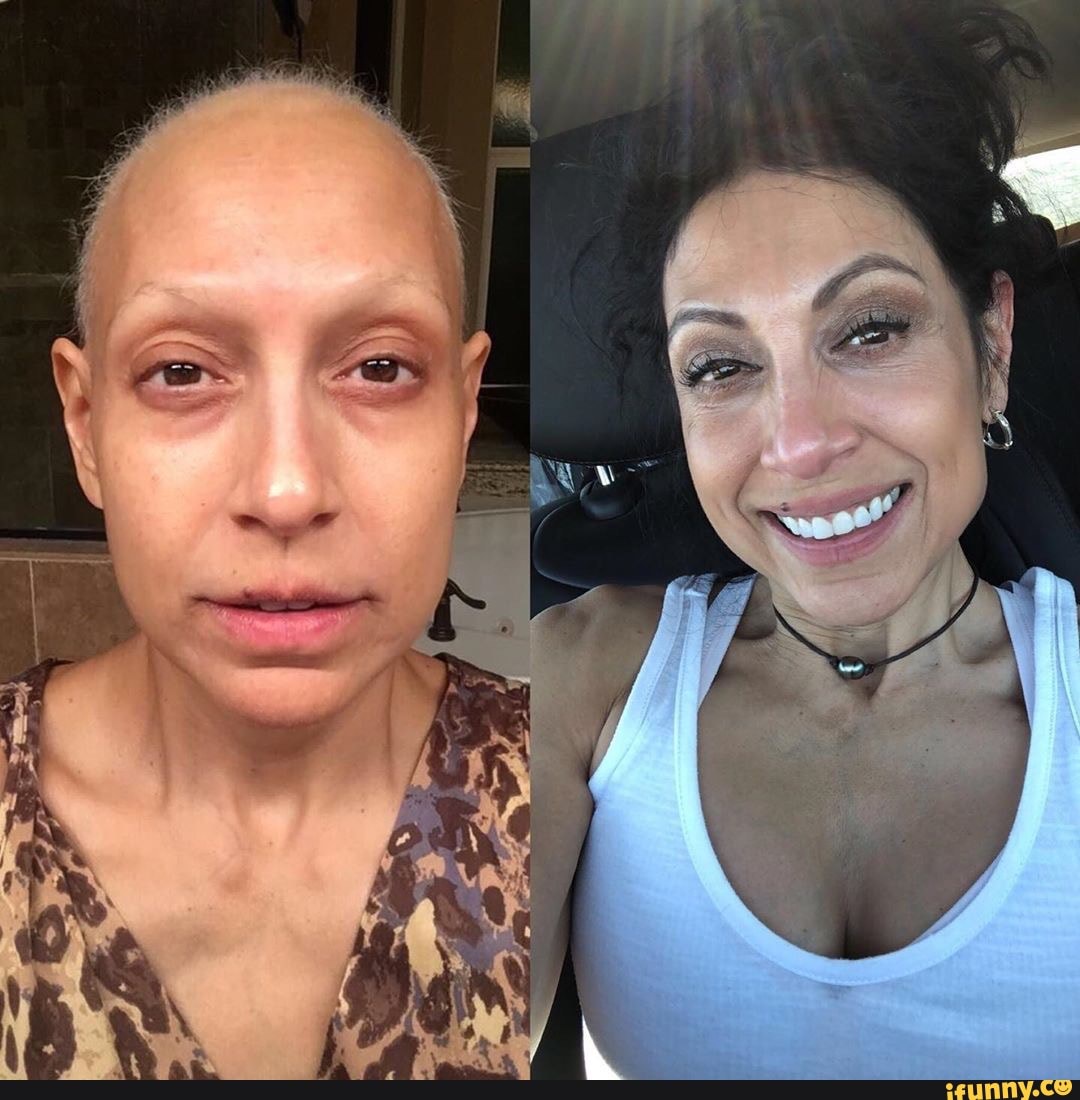 Победили рак сами. Люди до и после химиотерапии. Знаменитости победившие онкологию. Фото после химиотерапии женщин до и после. Люди с онкологией до и после.
