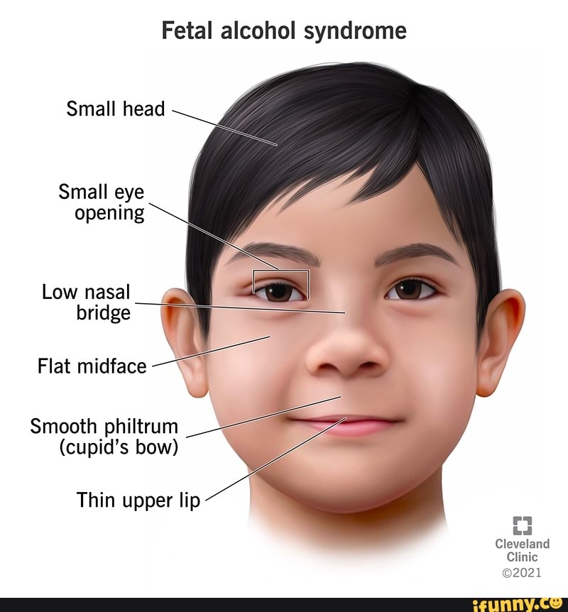 Fetal alcohol syndrome Small head Small eye opening Low nasal bridge ...