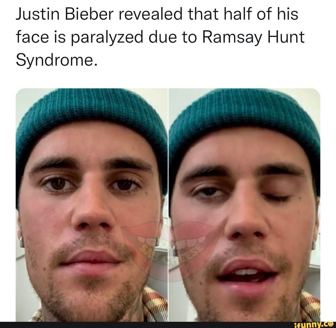 Justin Bieber Revealed That Half Of His Face Is Paralyzed Due To Ramsay Hunt Syndrome Ifunny 9609