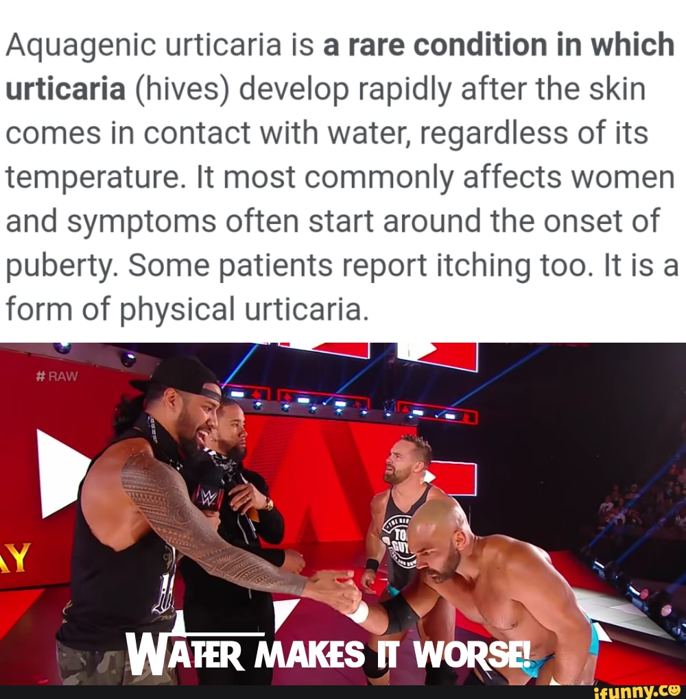 Aquagenic urticaria is a rare condition in which urticaria (hives