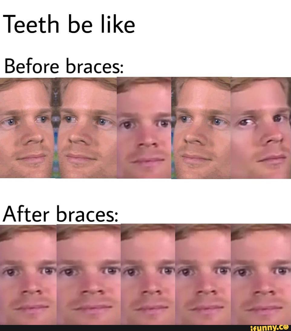 Teeth be like
Before braces: