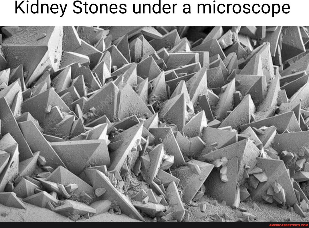 Kidney Stones under a microscope America’s best pics and videos