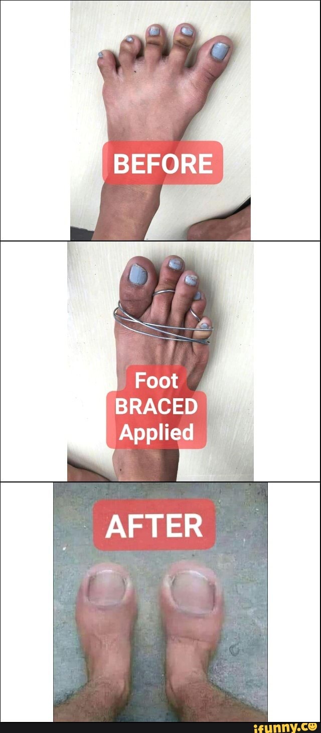 BEFORE
Foot
BRACED Applied
AFTER