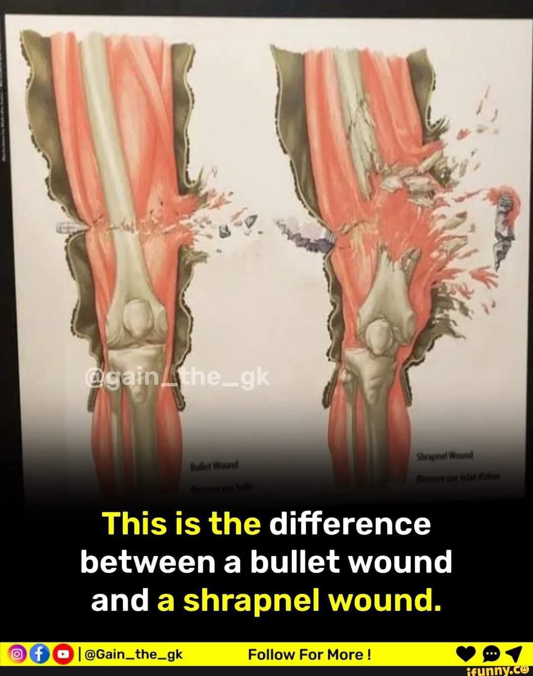 this-is-the-difference-between-a-bullet-wound-and-a-shrapnel-wound-fa