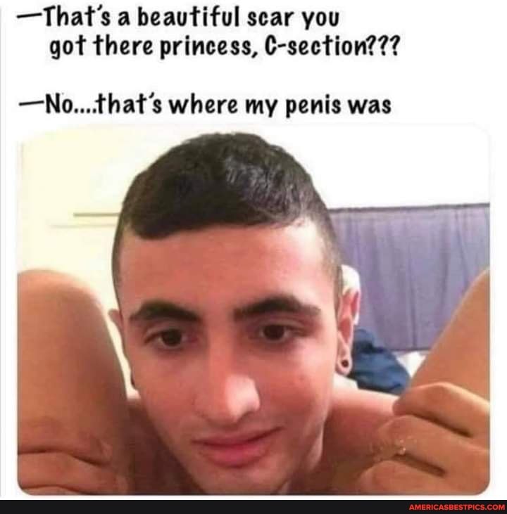 -That's a beautiful sear you got there princess, C-section???
-No...that's where my penis was