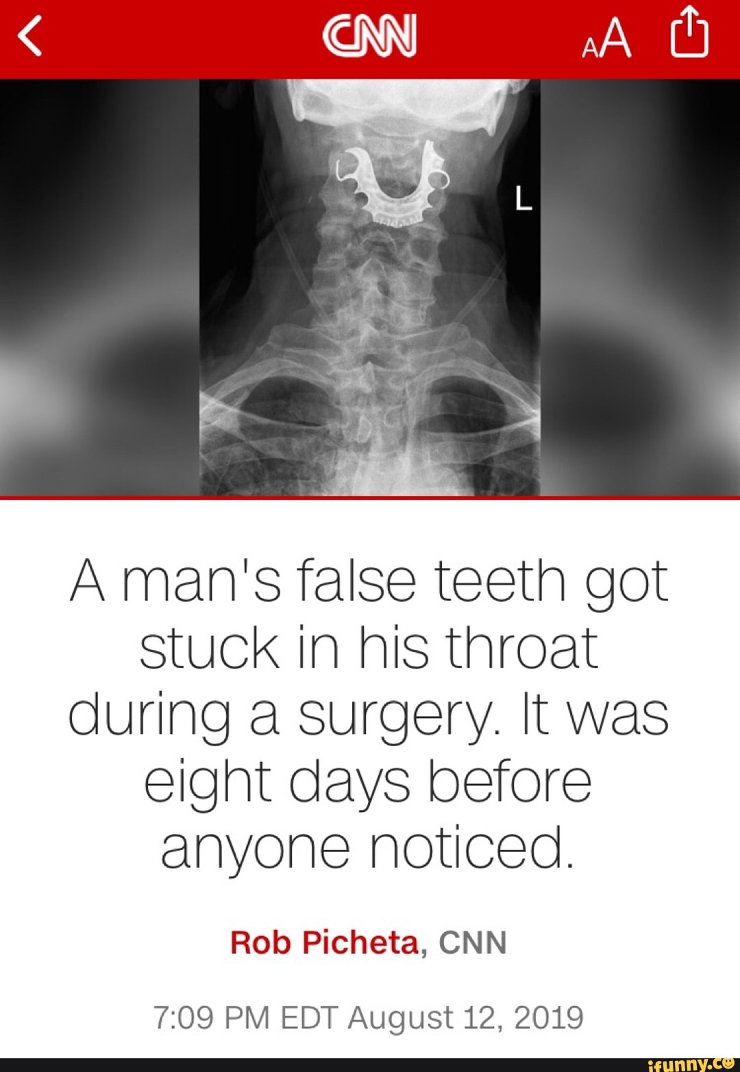 A Mans False Teeth Got Stuck In His Throat During A Surgery It Was Eight Days Before Anyone