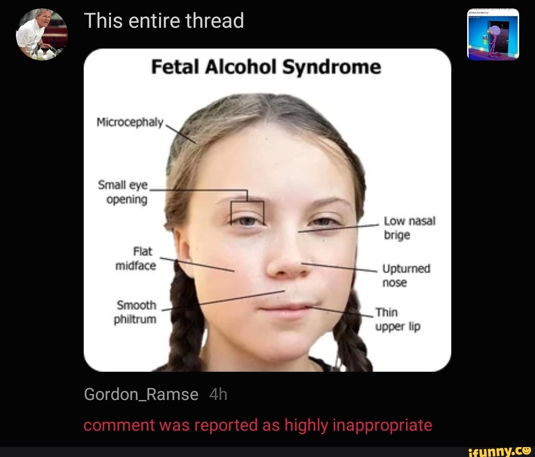 Fetal Alcohol Syndrome Eyes