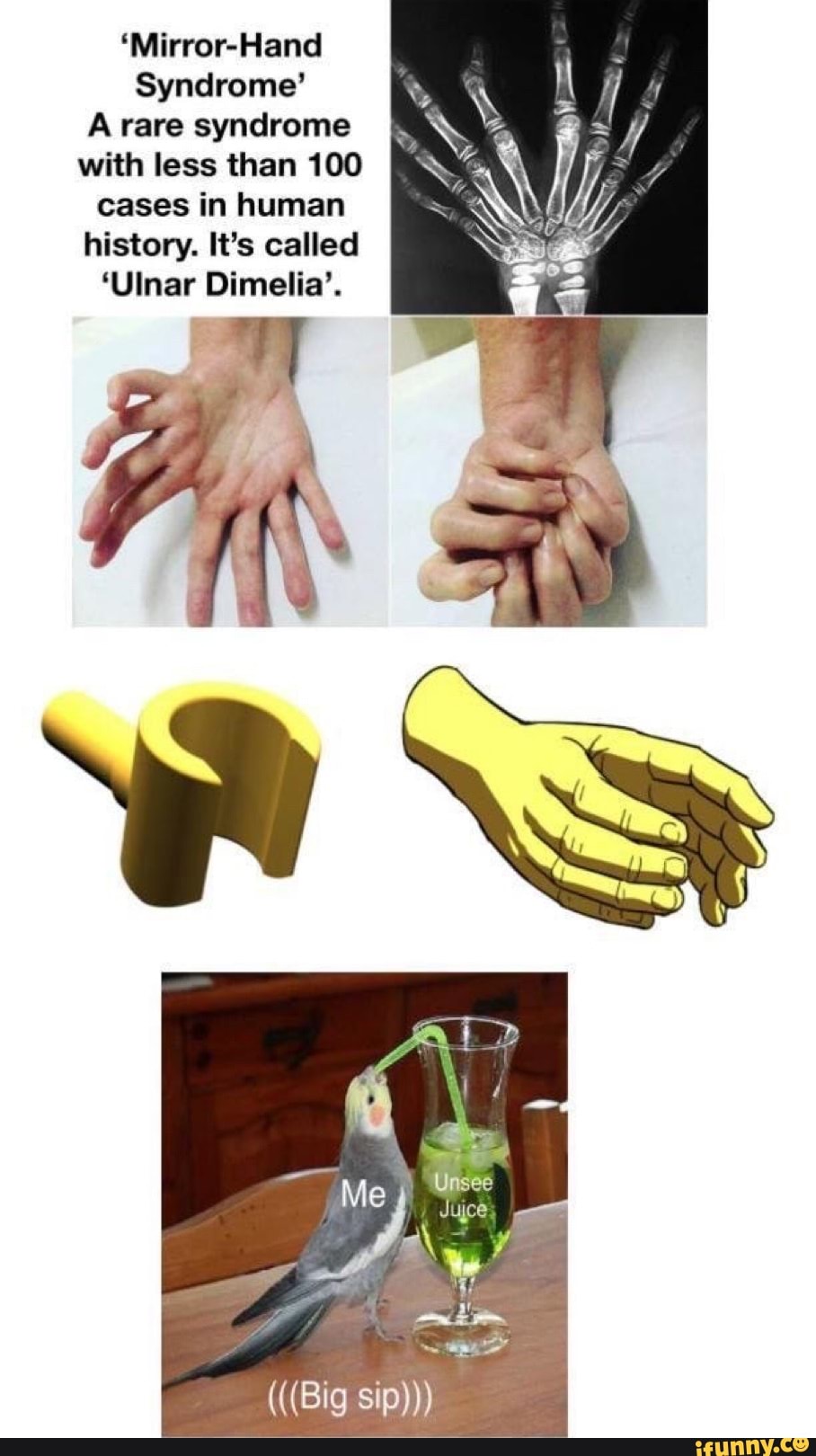 'MirrorHand Syndrome' A rare syndrome with less than 100 cases in