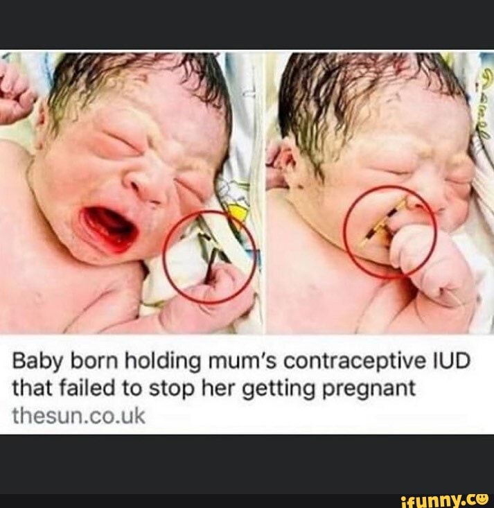 Baby born holding mum�s contraceptive IUD that failed to