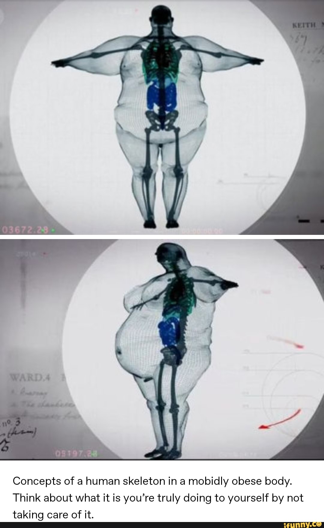 Concepts of a human skeleton in a mobidly obese body. Think about what ...