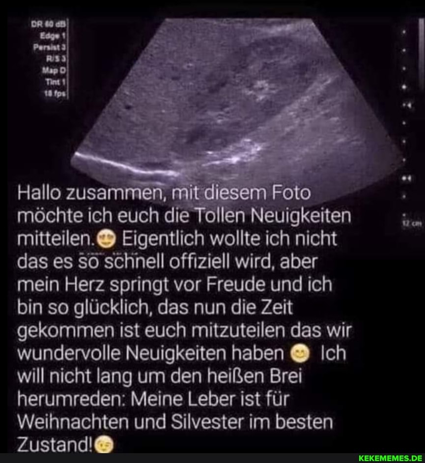 Hallo zusammen, mit diesem Foto möchte ich euch die Tollen Neuigkeiten mitteilen.@ Eigentlich wollte ich nicht das es schnell offiziell wird, aber mein Herz springt vor Freude und ich bin so glücklich, das nun die Zeit gekommen ist euch mitzuteilen das wir wundervolle Neuigkeiten haben Ich will nicht lang um den heißen Brei herumreden: Meine Leber Ist für
Weihnachten und Silvester im besten
Zustand!@