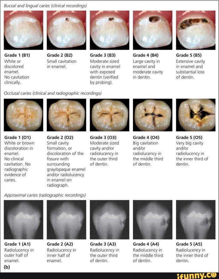 Buccal and lingual caries (clinical recordings) Grade 1 Grade 2 White