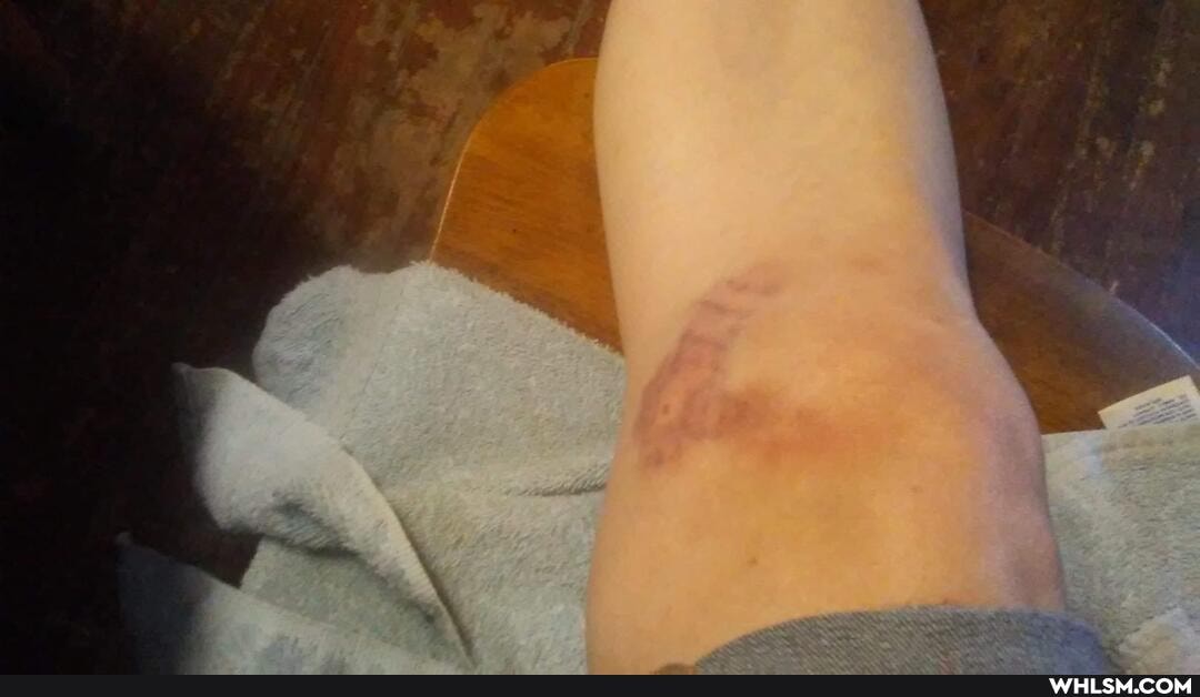 horse, injury, bites