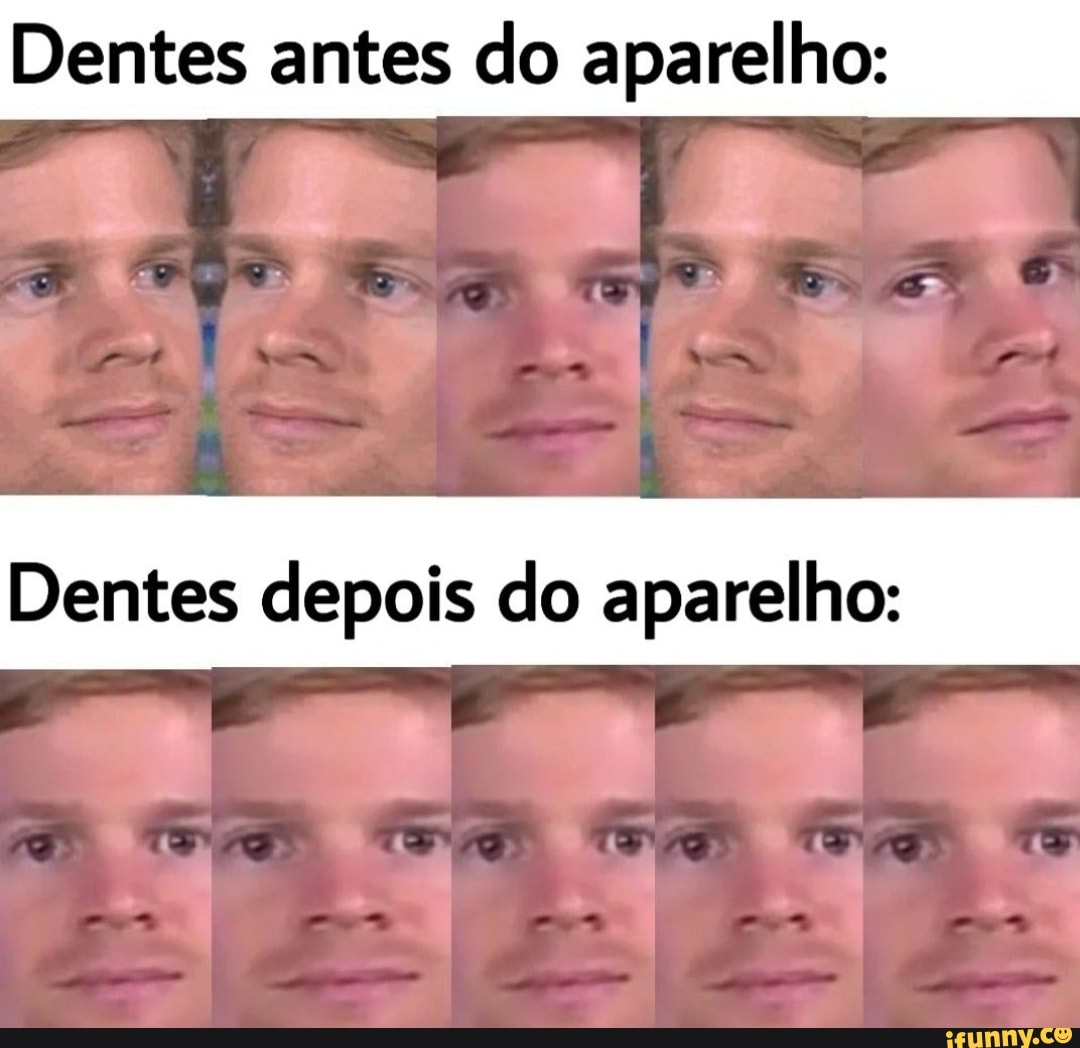 Dentes antes do aparelho:
Dentes depois do aparelho: