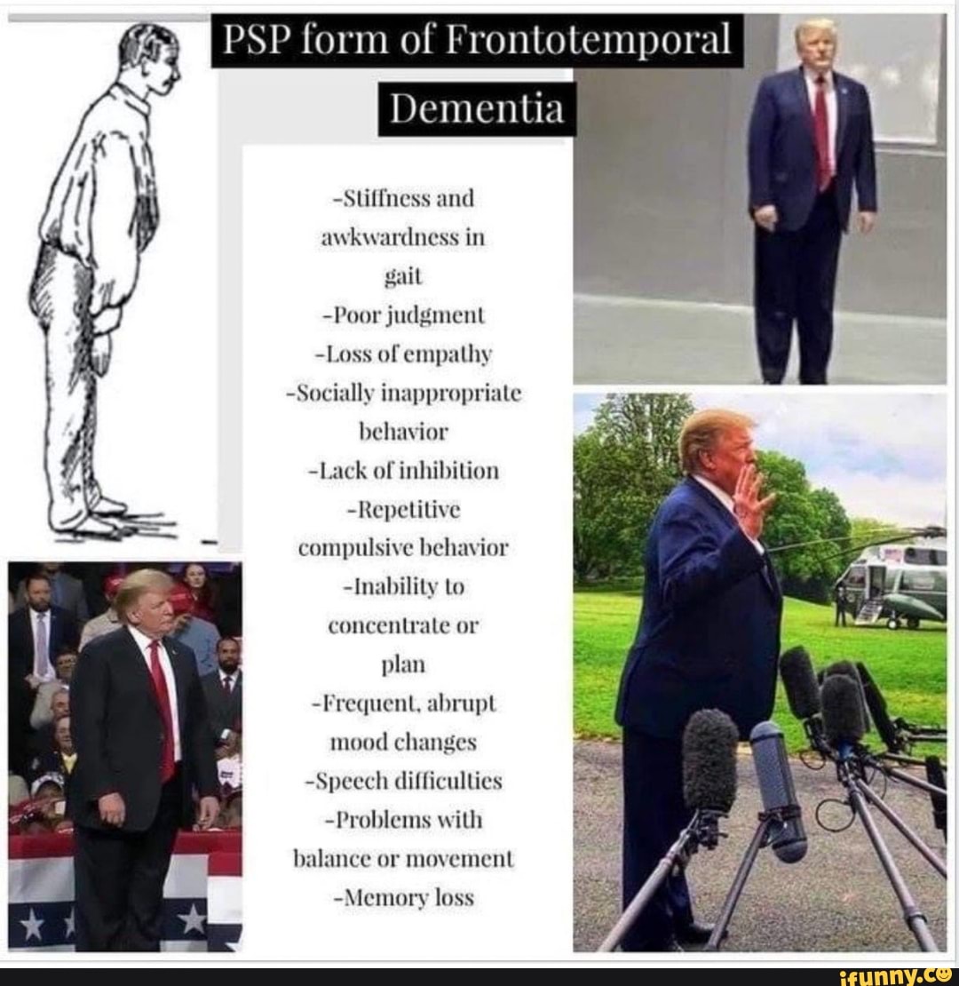 PSP form of Frontotemporal Dementia Stiffness and awkwardness in gail