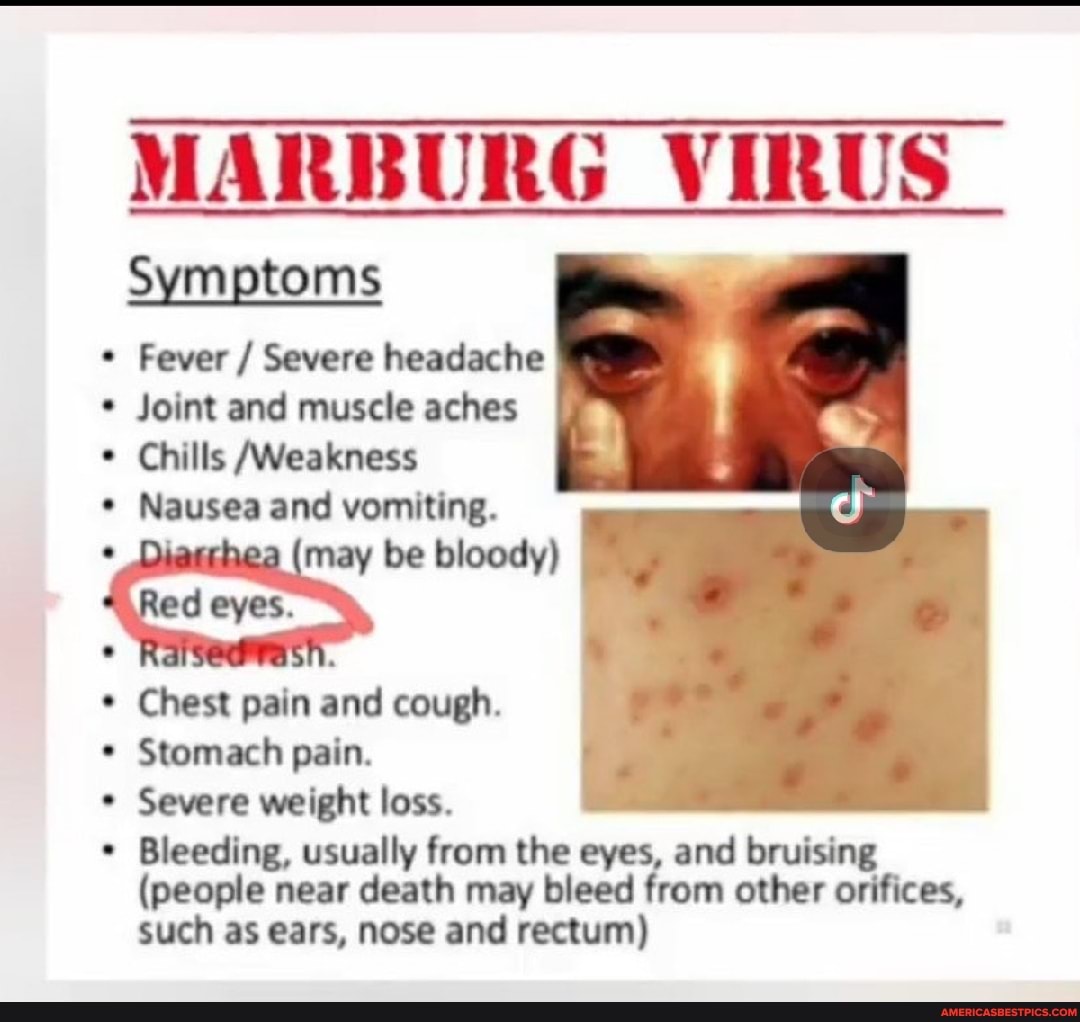 Symptoms MARBURG VIRUS Fever / Severe headache * Joint and muscle aches Chills /Weakness