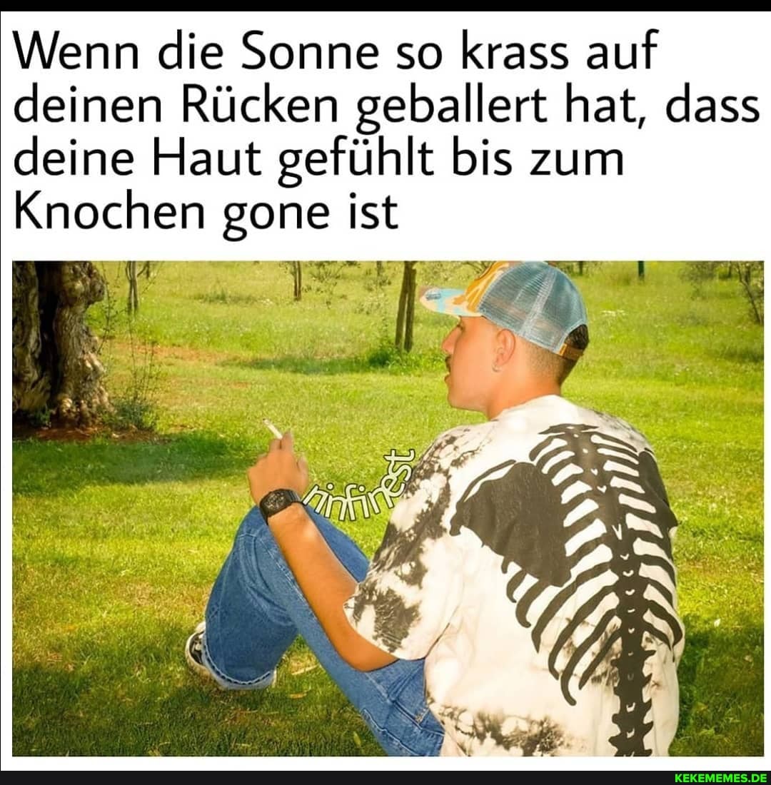 Wenn die Sonne so krass auf deinen Rücken geballert hat, dass deine Haut gefühlt bis zum
Knochen gone ist