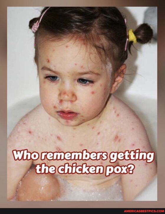 Who remembers getting the chicken pox?