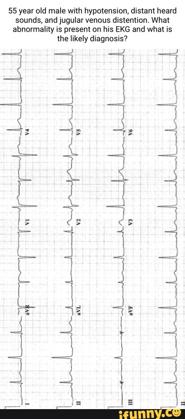 Ekg memes. Best Collection of funny Ekg pictures on iFunny