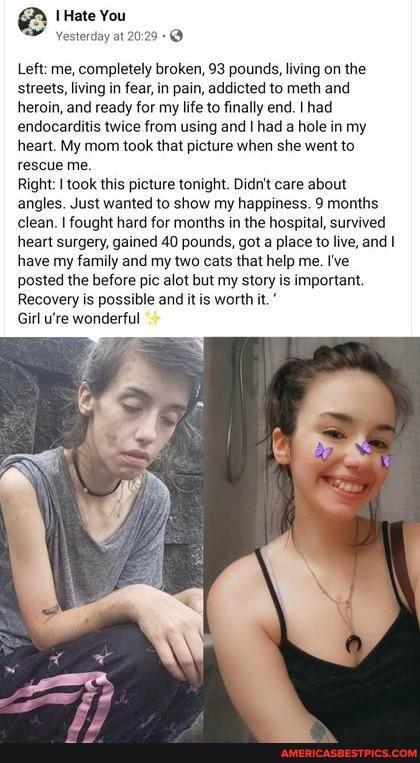 Hate You
Left: me, completely broken, 93 pounds, living on the
'streets, living in fear, in pain, addicted to meth and heroin, and ready for my life to finally end. I had endocarditis twice from using and I had a hole in my heart. My mom took that picture when she went to rescue me.
Right: I took this picture tonight. Didn't care about angles. Just wanted to show my happiness. 9 months clean. I fought hard for months in the hospital, survived heart surgery, gained 40 pounds, got a place to live, and I have my family and my two cats that help me. I've posted the before pic alot but my story is important.
Recovery is possible and it is worth it
Girl u're wonderful
