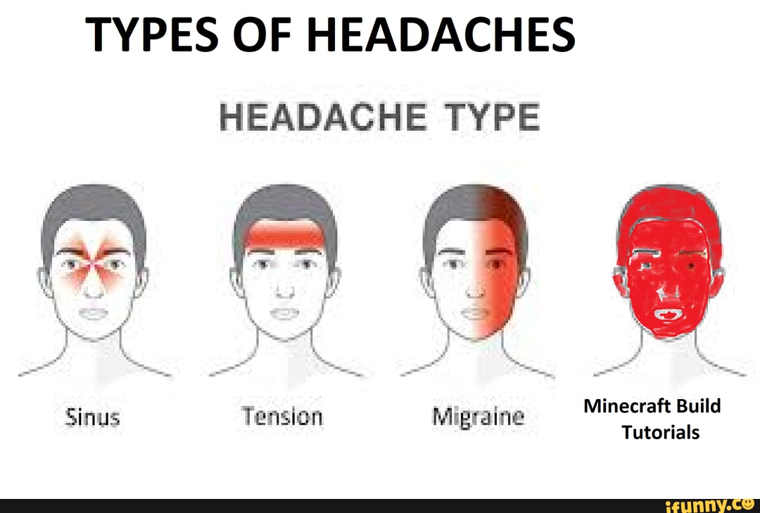 TYPES OF HEADACHES HEADACHE TYPE Sinus Tension Migraine Tutorials ...