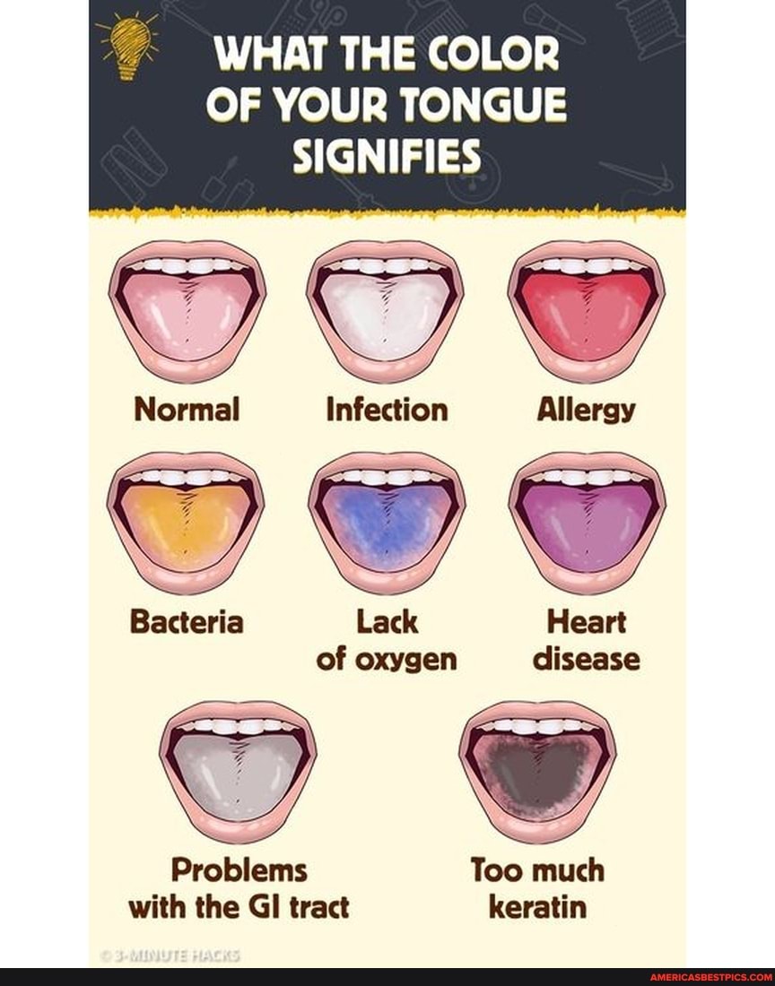 WHAT THE COLOR OF YOUR TONGUE SIGNIFIES Normal Infection Allergy ...