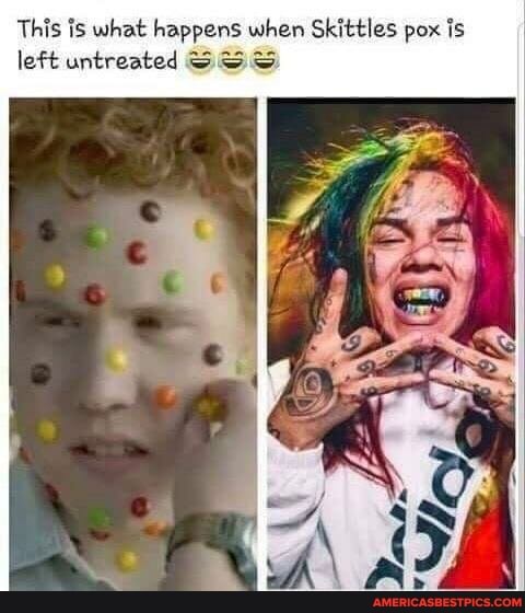 This is what happens when Skittles pox is
left untreated SS