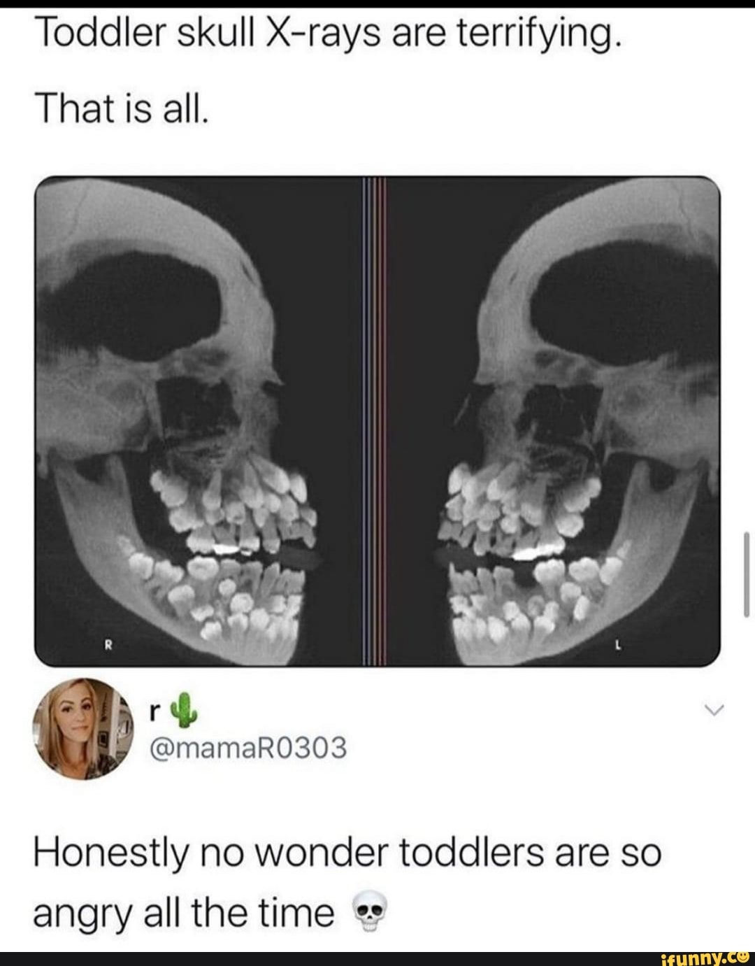 Toddler skull X-rays are terrifying. That is all. Honestly no wonder