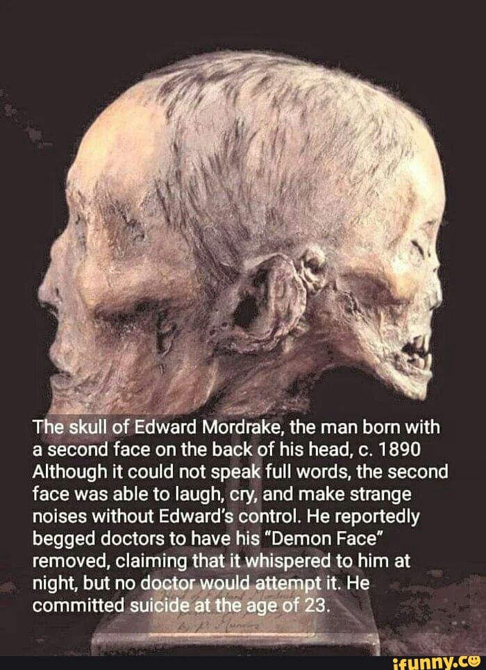 The kúll of Edward Mordlake. the man born with
a second face on the back of his head, c. 1890
Although it could not speak full words. the second
face was able to laugh, cry, and make strange
noises without Edward's control. He reportedly
begged doctors to have his "Demon Face'
removed, claiming that it whispered to him at
night, but no d » .
t He
committed s