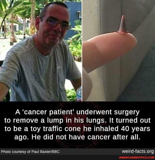 A 'cancer patient' underwent surgery to remove a lump in his lungs. It turned out to be a toy traffic cone he inhaled 40 years ago. He did not have cancer after all.
Photo courtesy of Paul