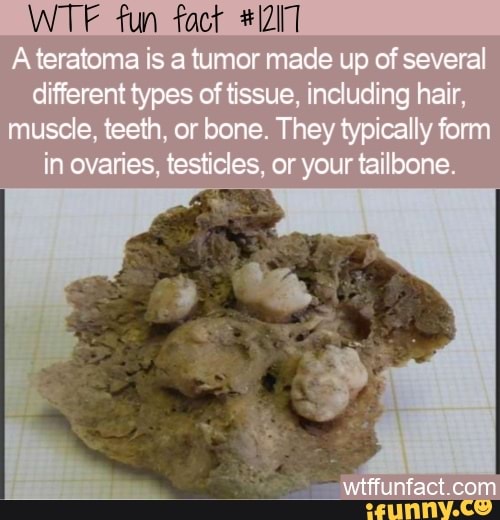 Fun A Teratoma Is A Tumor Made Up Of Several Different Types Of Tissue