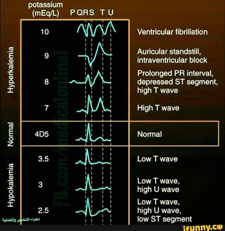 Ventricular ﬂbrillaﬂon Auricular standstill, intraventticular block ...