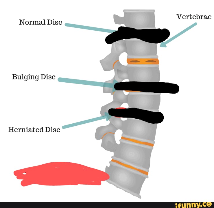 Vertebrae Normal Disc Bulging Disc Herniated Disc iFunny