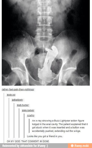 lodged inthe ana cavity. The patient explsined that t
got tuck when was inserte and a buton was.
aceientaly pushed, extending out the wings.
Looks te 0 gota fend in you.
OH MY GOD. THAT COMMENT. 14 DONE.