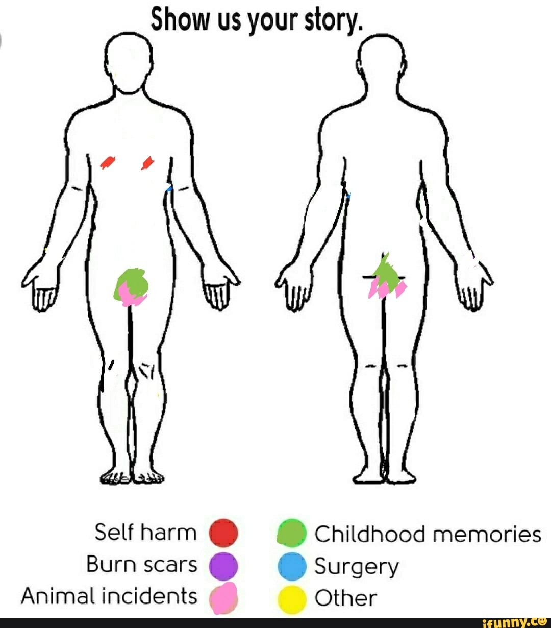 Show Us Your Story Selfharm F Ll Childhood Memories Burn Scars Surgery V Animal Incidents Other