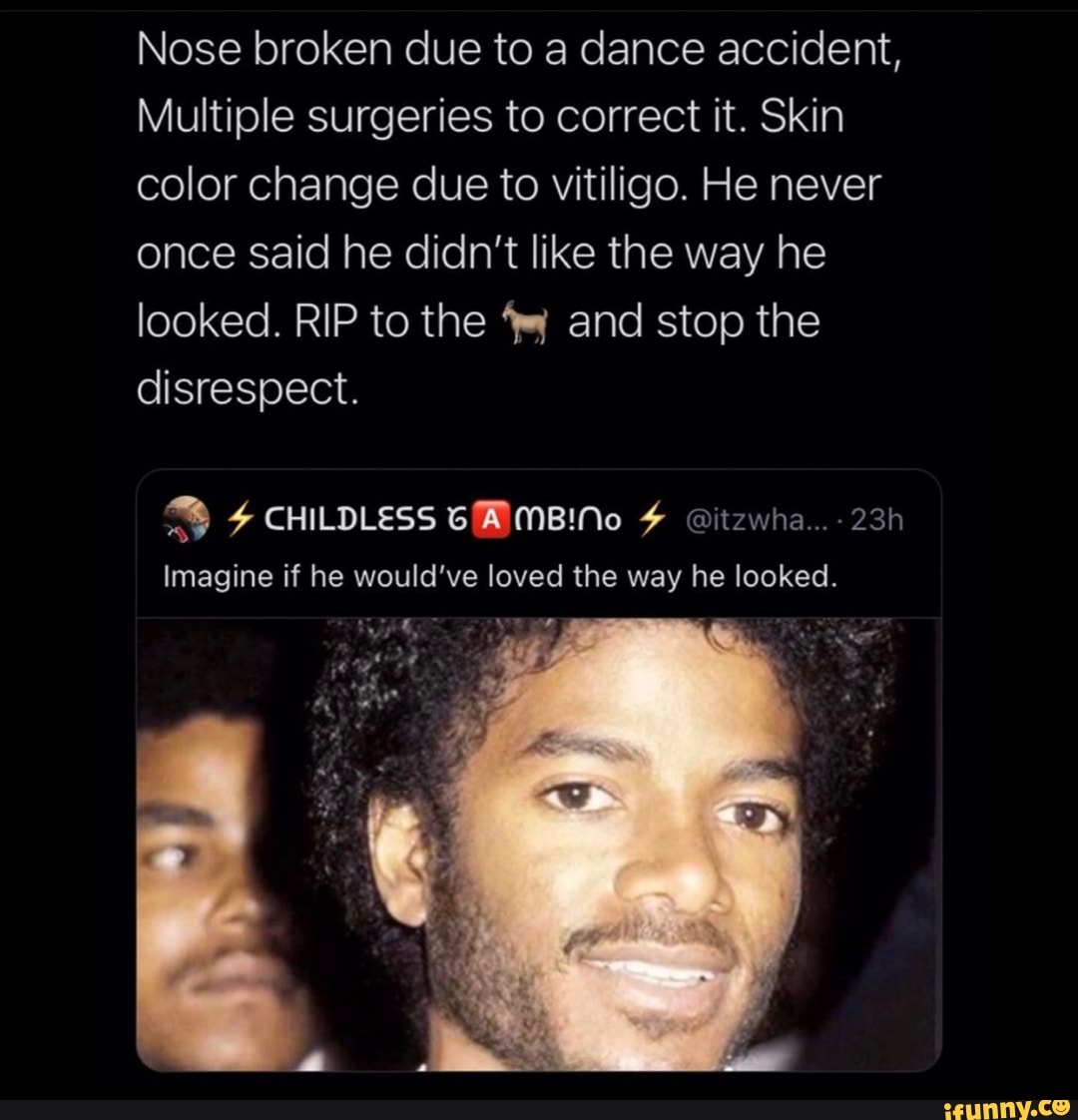 Nose broken due to a dance accident, Multiple surgeries to correct it