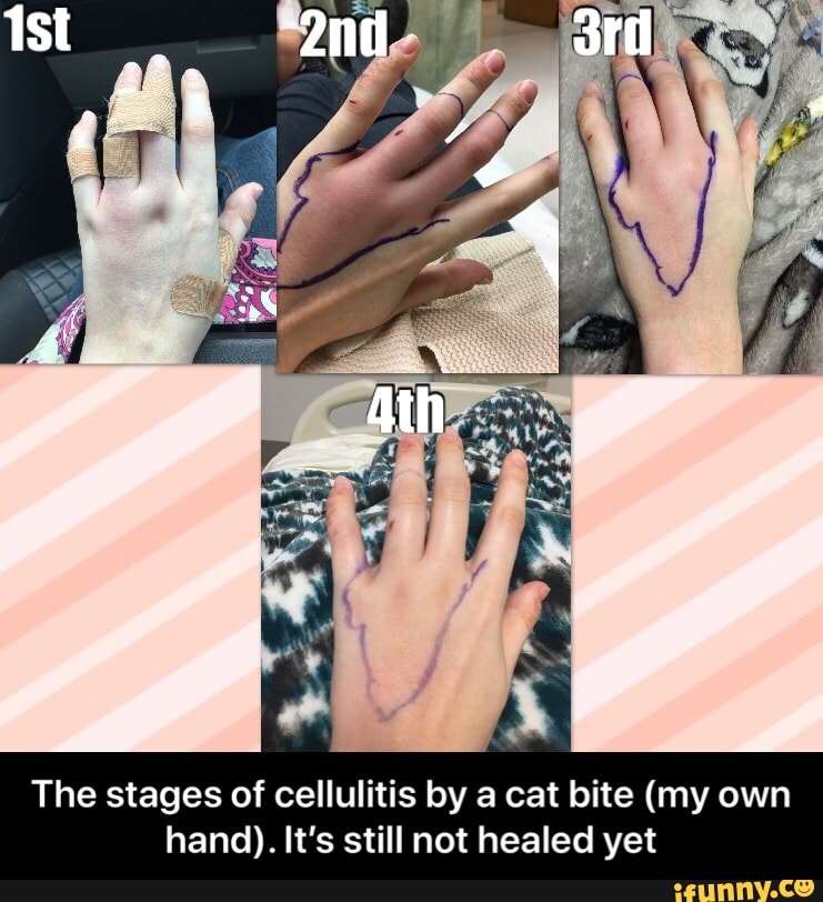 The stages of cellulitis by a cat bite (my own hand). It's still not