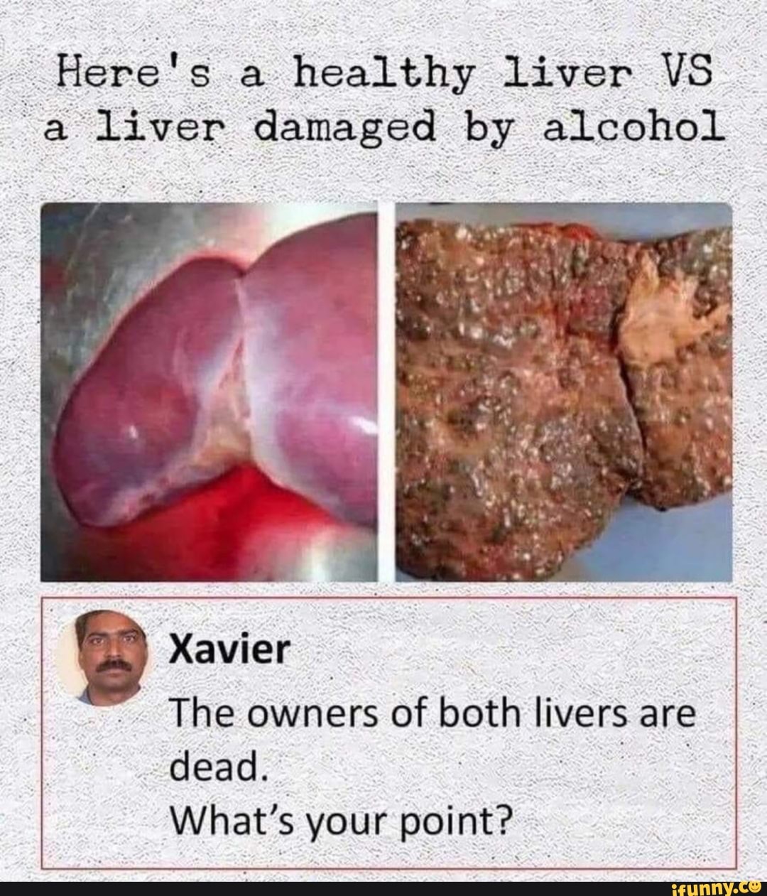 Here's a healthy liver VS liver damaged by alcohol
Xavier
The owners of both livers are dead.
What's your point?