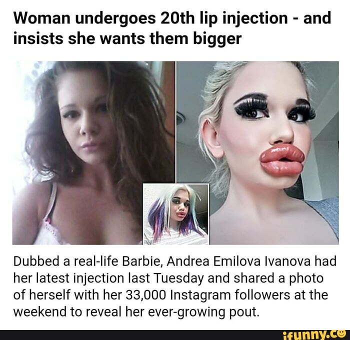 Woman undergoes 20th lip injection - and insists she wants ...