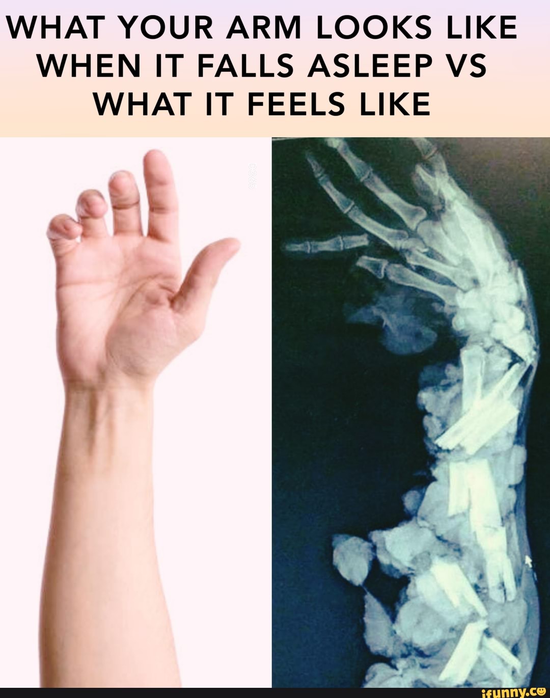 what-your-arm-looks-like-when-it-falls-asleep-vs-what-it-feels-like