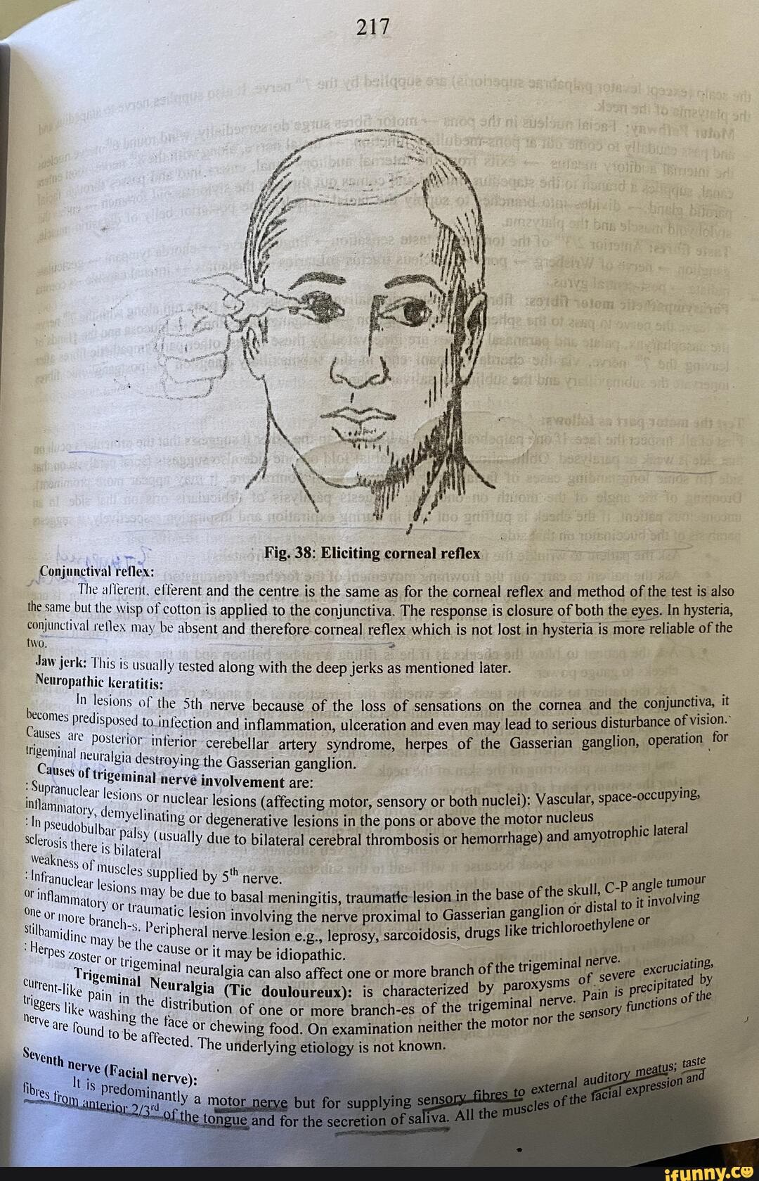 217 Fig. 38: Eliciting corneal reflex Conjuactival The rent, efferent ...